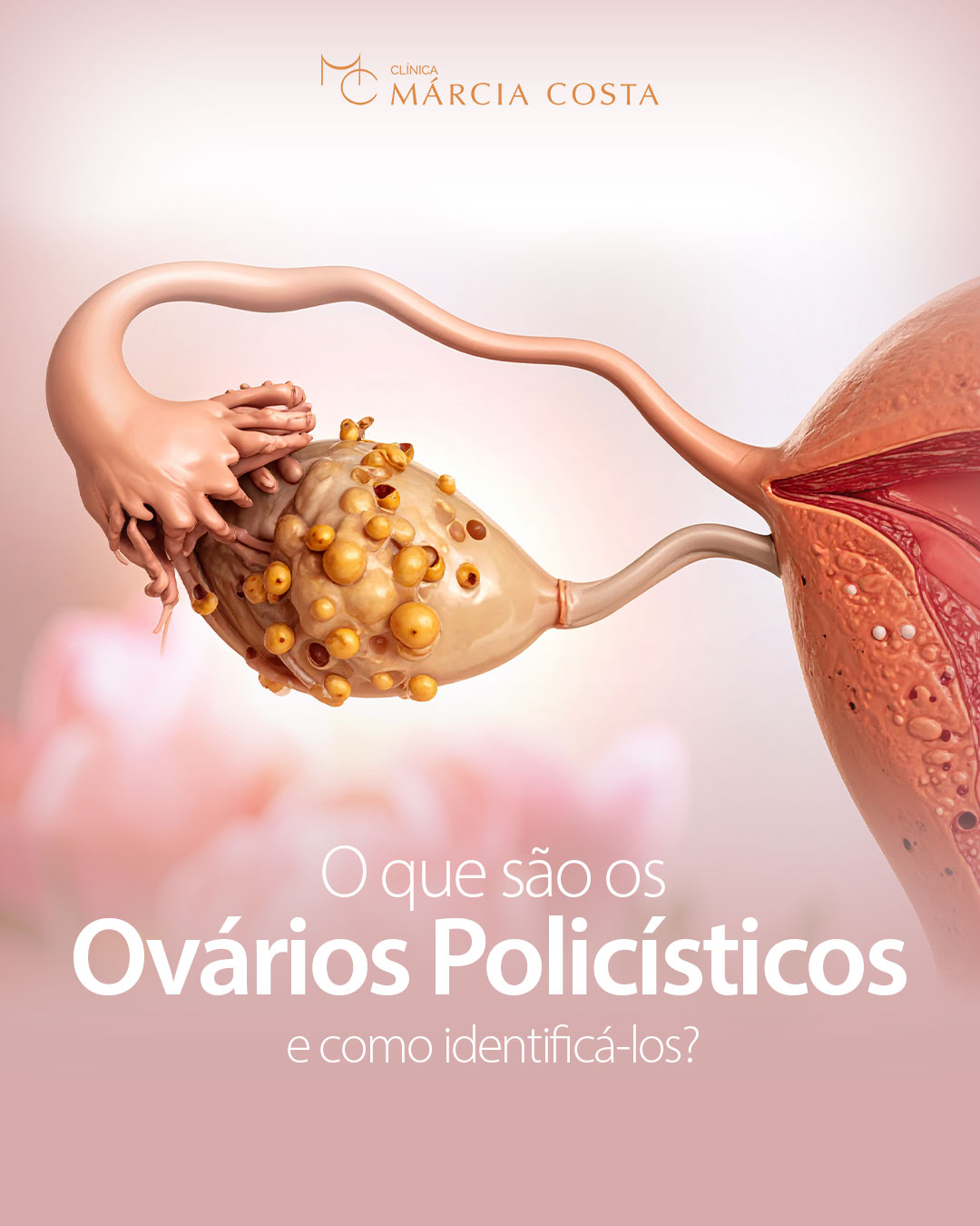 O que são os ovários policísticos e como identificá-los?